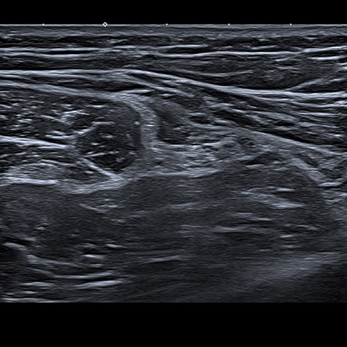 SportsMed Thigh Ultrasound // Hamstring