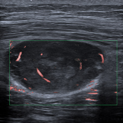 SportsMed Thigh Ultrasound // Spindle cell lesion 1