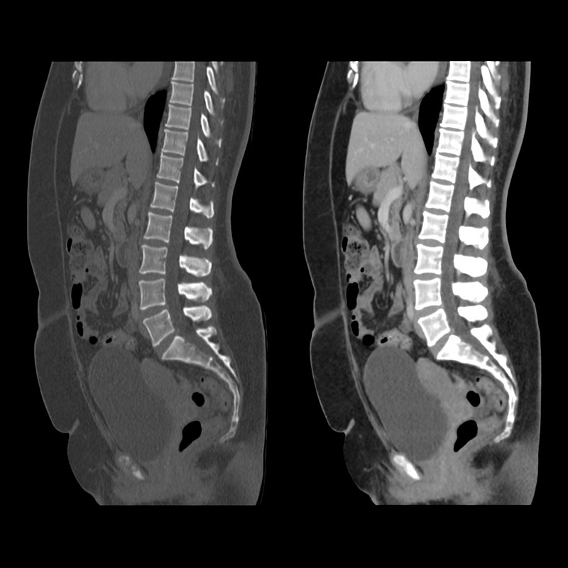 Aquilion Prime SP Abdomen and Pelvis