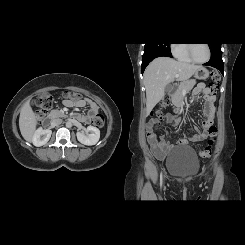 Aquilion Prime SP Abdomen and Pelvis