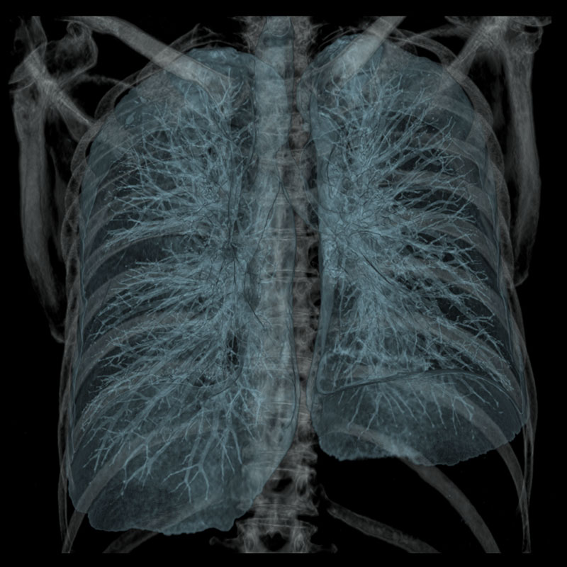Aquilion Prime SP Lung CT, 1.3 mGy