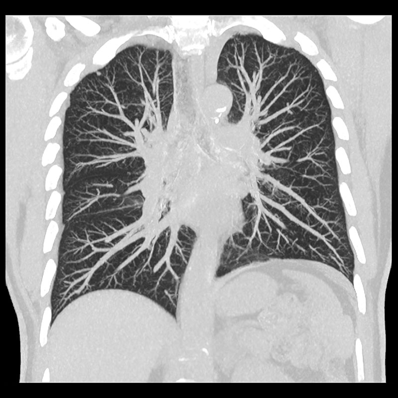 Aquilion Prime SP Lung CT, 1.3 mGy