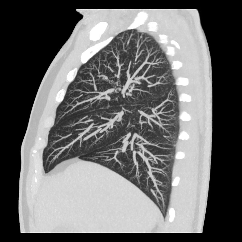 Aquilion Prime SP Lung CT, 1.3 mGy