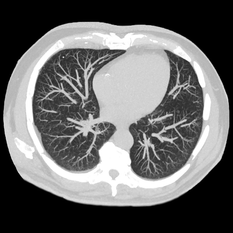 Aquilion Prime SP Lung CT, 1.3 mGy