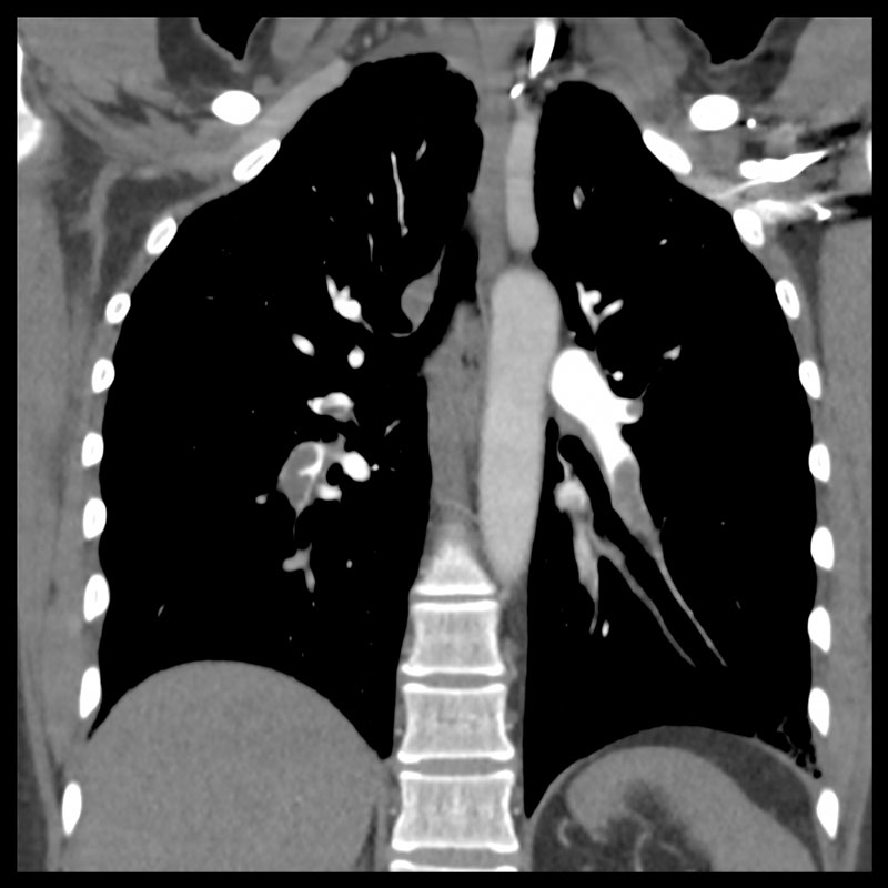 Aquilion Prime SP Pulmonary Embolism