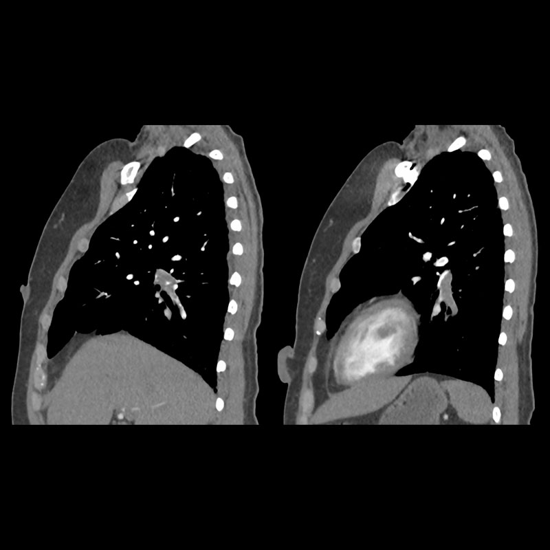 Aquilion Prime SP Pulmonary Embolism