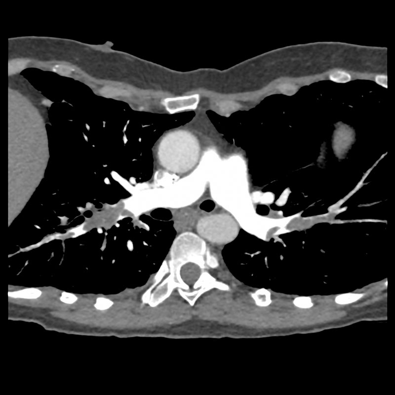 Aquilion Prime SP Pulmonary Embolism