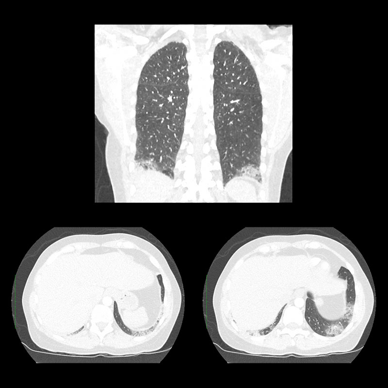 Aquilion Prime SP Pulmonary Embolism