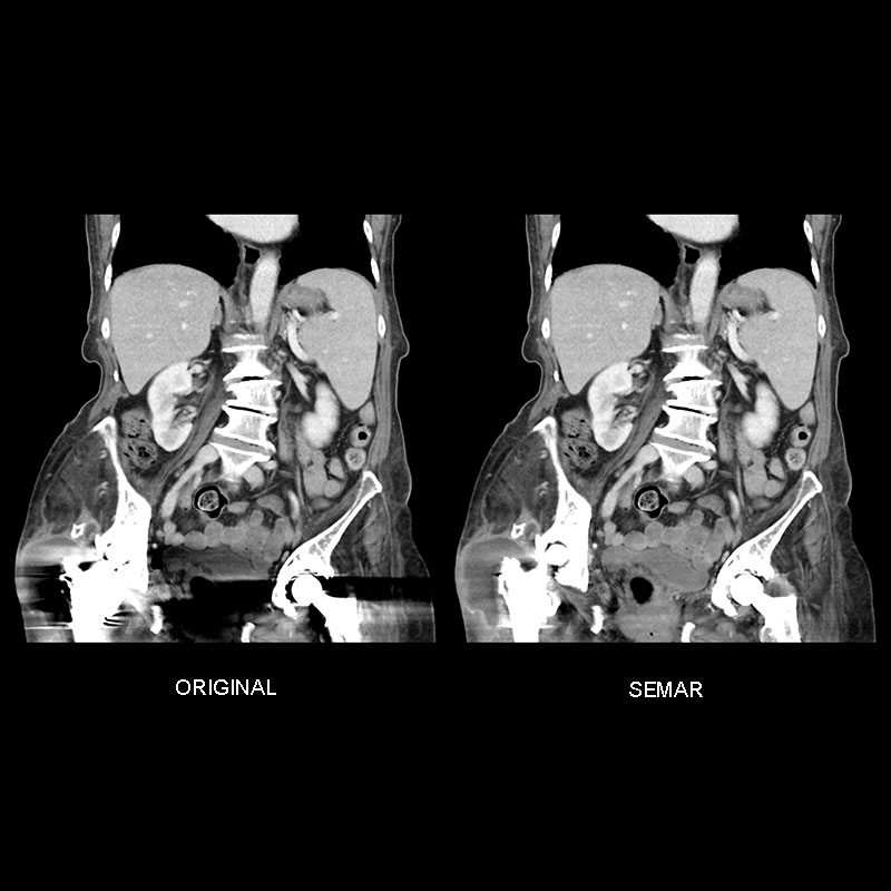 Aquilion Prime SP SEMAR, Prosthetic Joint Infection