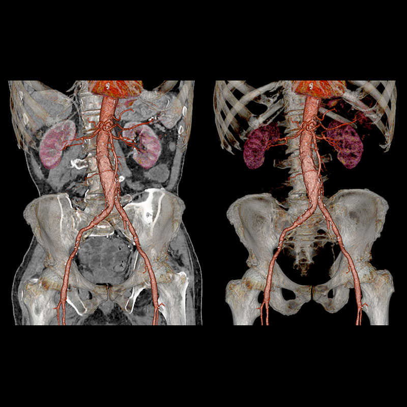Aquilion Prime SP SURESubtraction, Aortic Aneurism