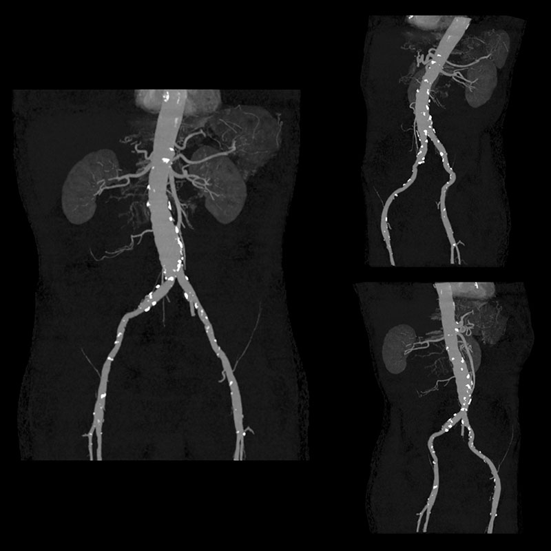 Aquilion Prime SP SURESubtraction, Aortic Aneurism