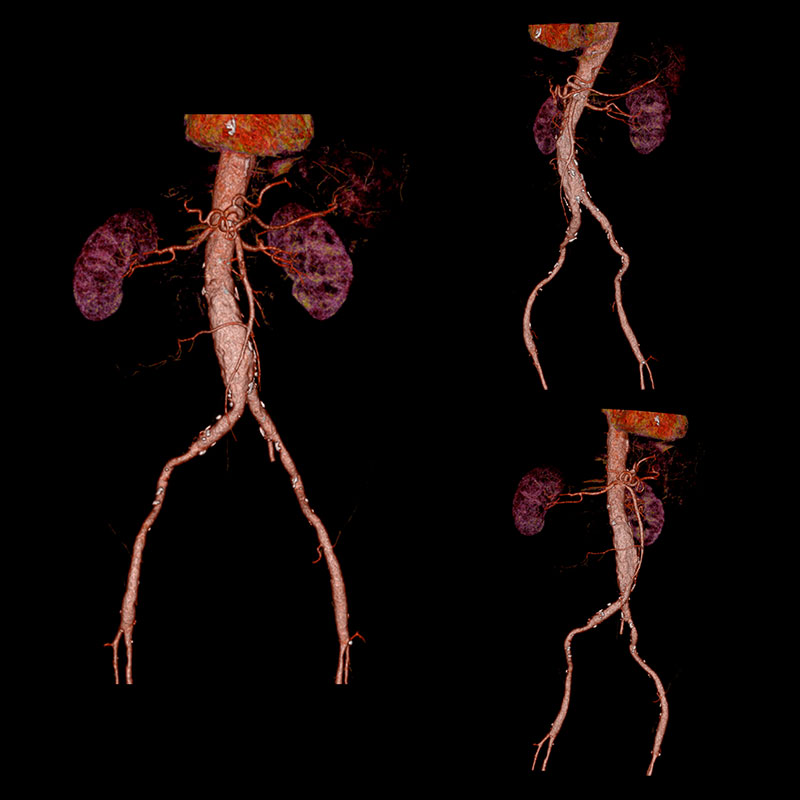 Aquilion Prime SP SURESubtraction, Aortic Aneurism