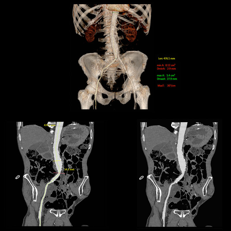 Aquilion Prime SP SURESubtraction, Aortic Aneurism