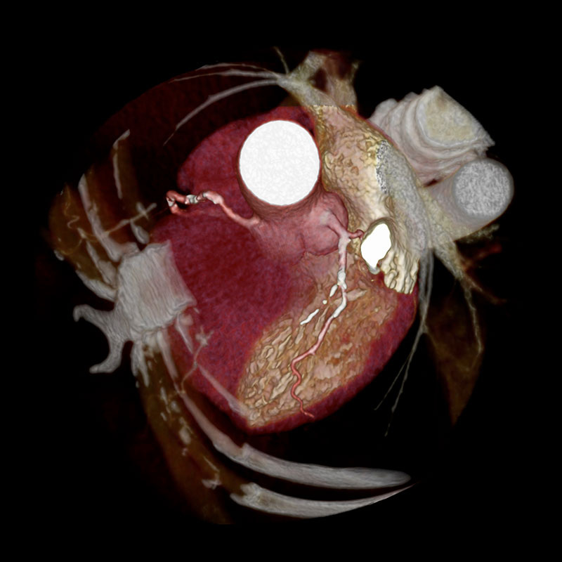 Aquilion Prime SP Coronary Artery Disease