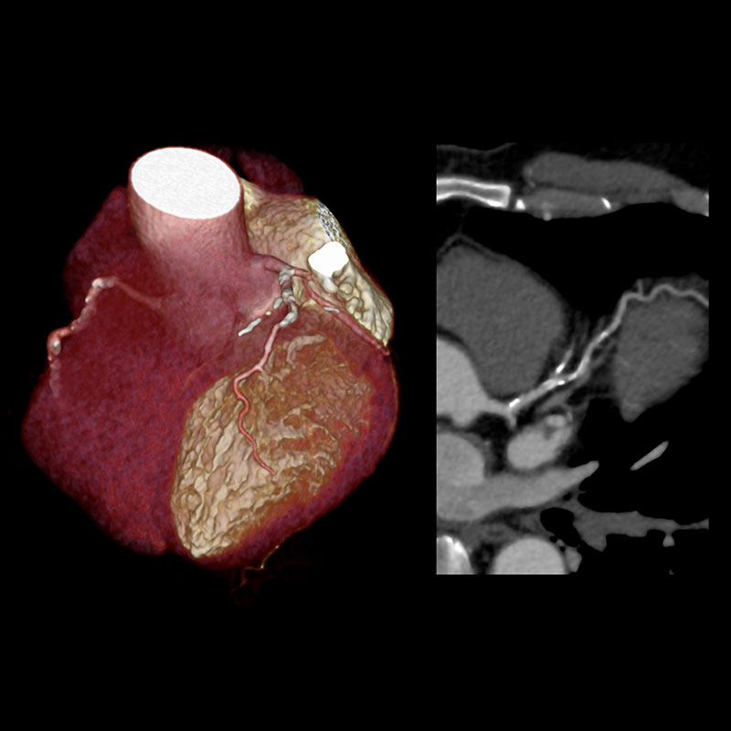 Aquilion Prime SP Coronary Artery Disease
