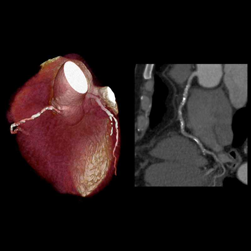 Aquilion Prime SP Coronary Artery Disease