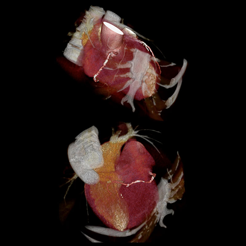 Aquilion Prime SP Coronary Artery Disease