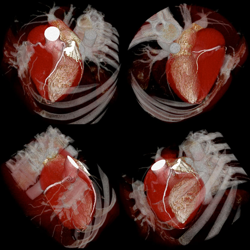 Aquilion Prime SP Cardiac CTA