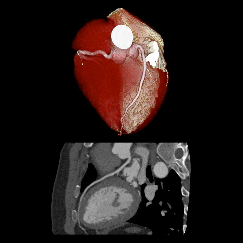 Aquilion Prime SP Cardiac CTA