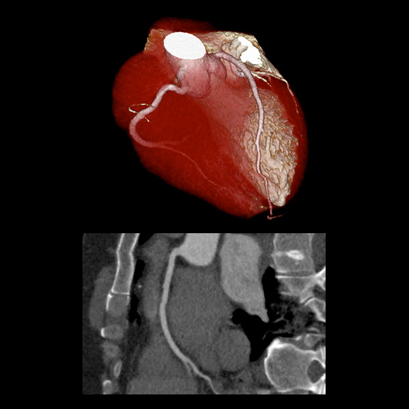 Aquilion Prime SP Cardiac CTA