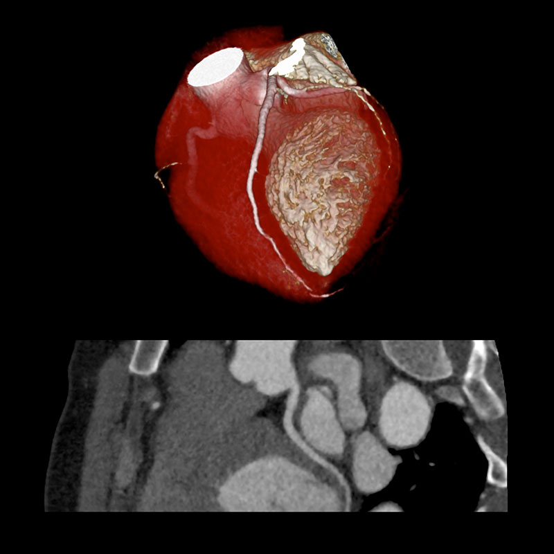 Aquilion Prime SP Cardiac CTA