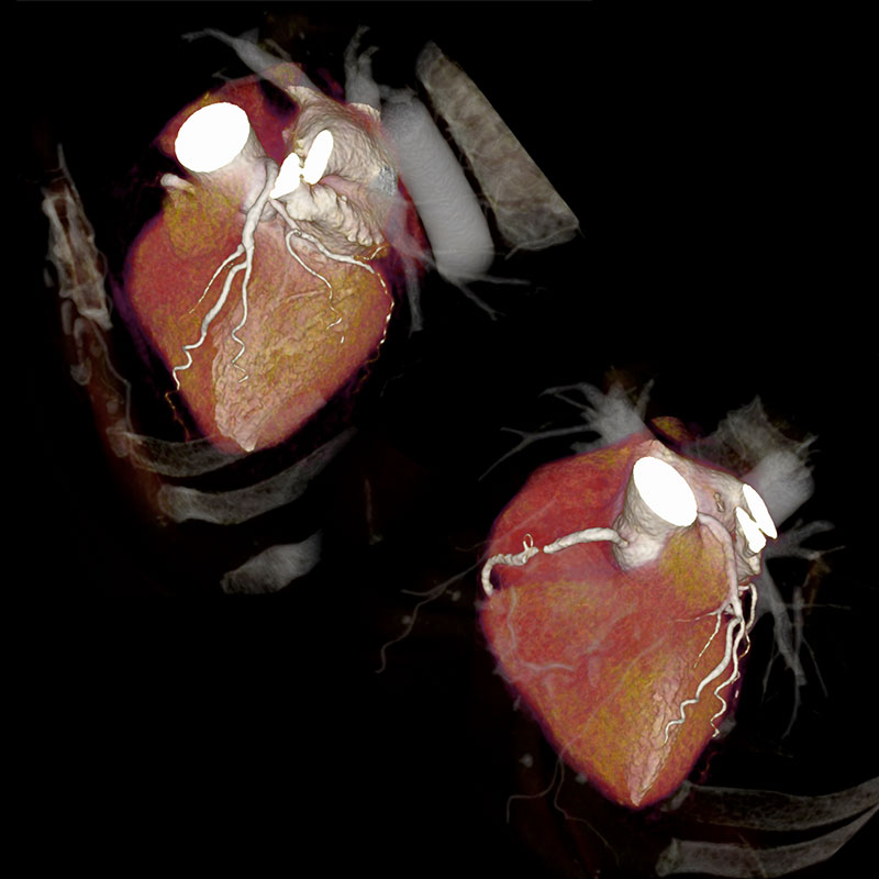 Aquilion Prime SP RCA Stenosis