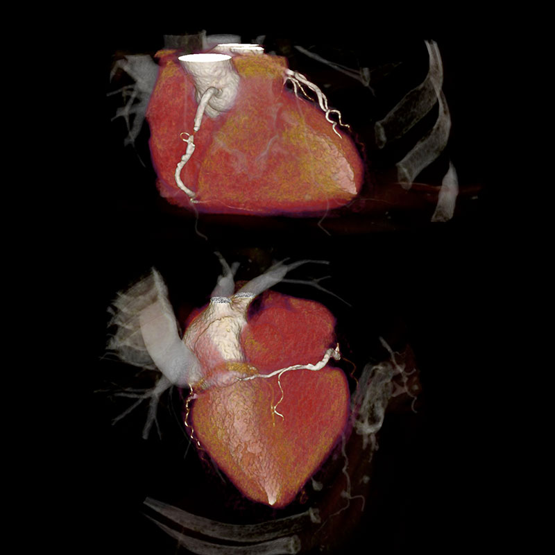 Aquilion Prime SP RCA Stenosis