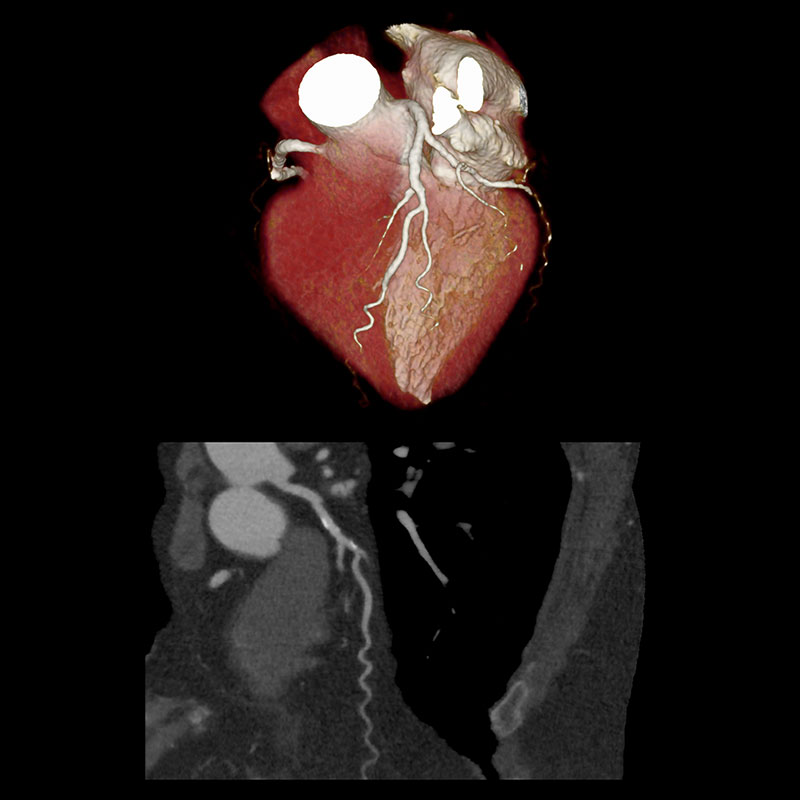 Aquilion Prime SP RCA Stenosis