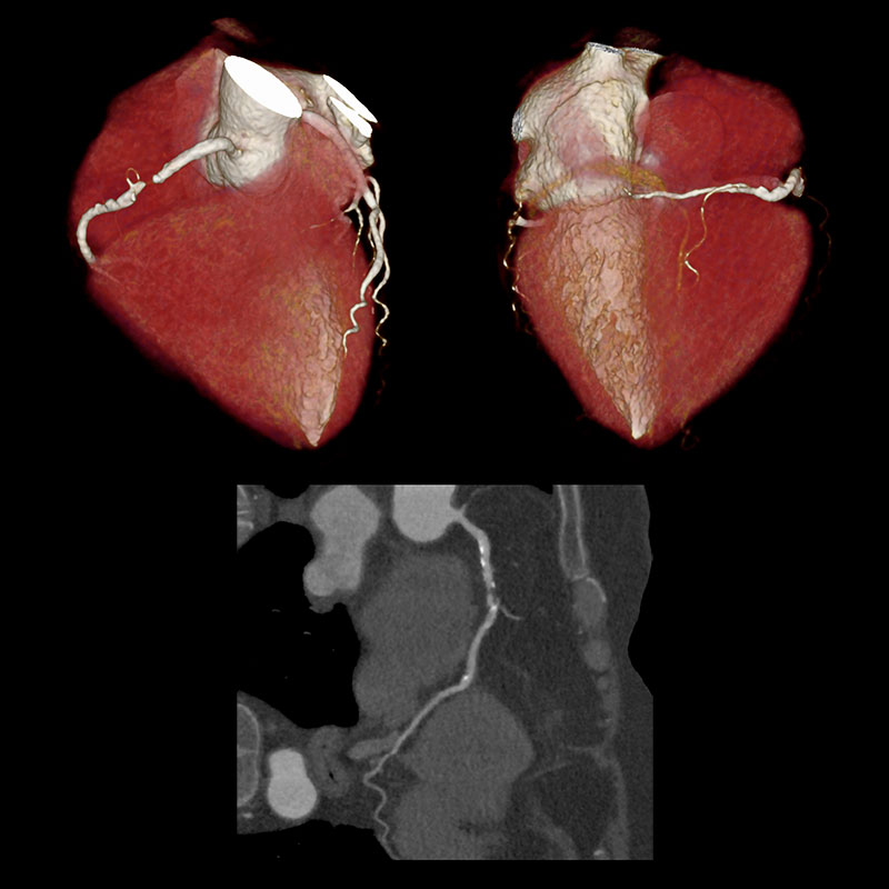 Aquilion Prime SP RCA Stenosis