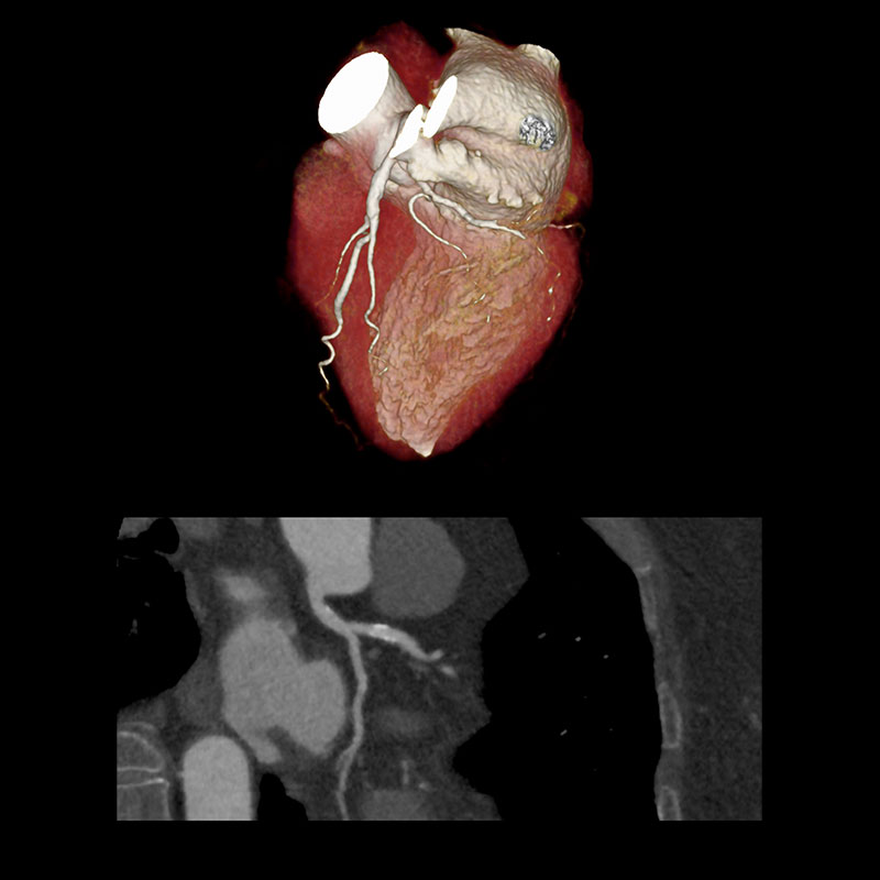 Aquilion Prime SP RCA Stenosis