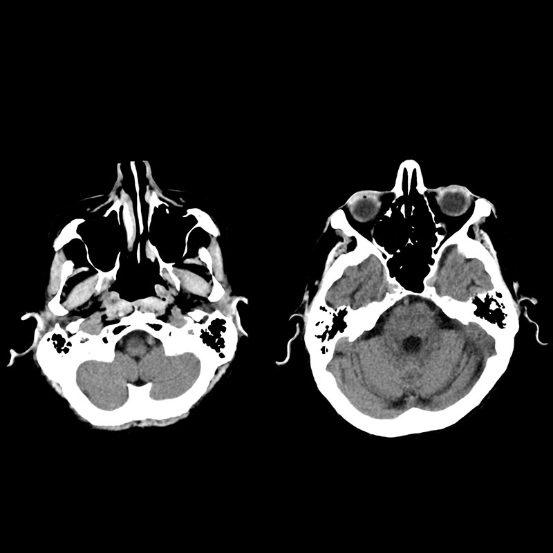 Aquilion Prime SP Cerebral Atrophy