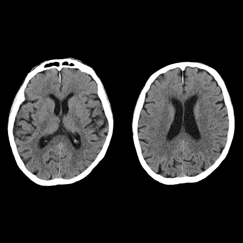 Aquilion Prime SP Cerebral Atrophy
