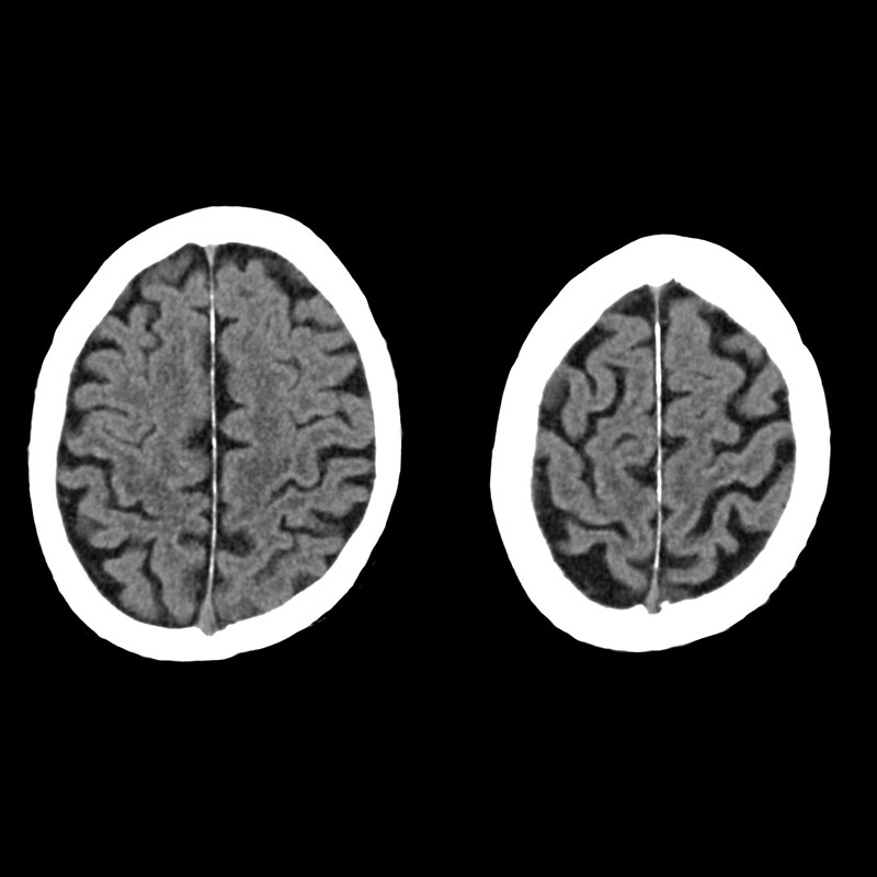 Aquilion Prime SP Cerebral Atrophy
