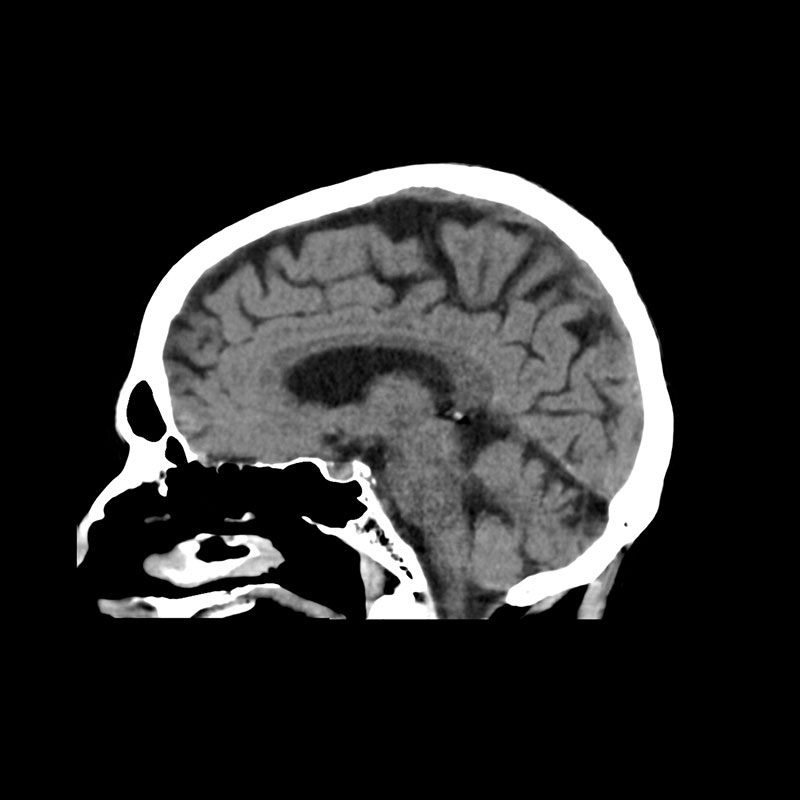 Aquilion Prime SP Cerebral Atrophy