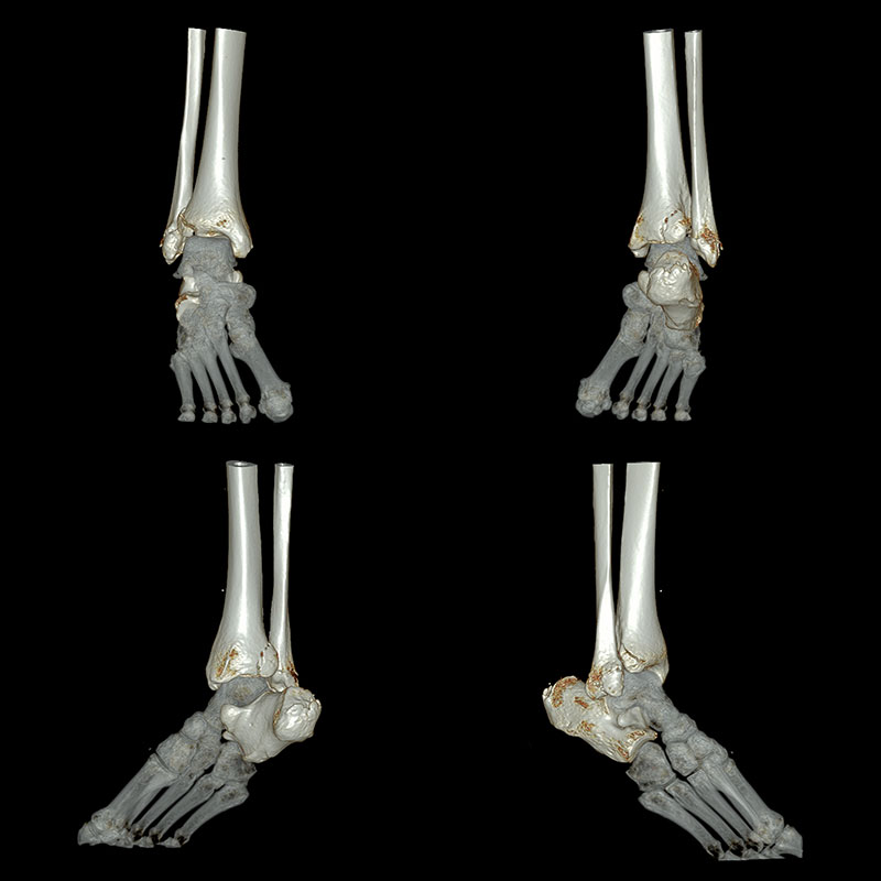 Aquilion Prime SP Ankle Fracture