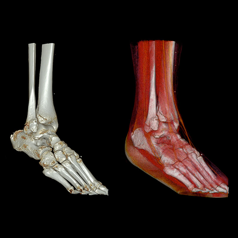Aquilion Prime SP Ankle Fracture