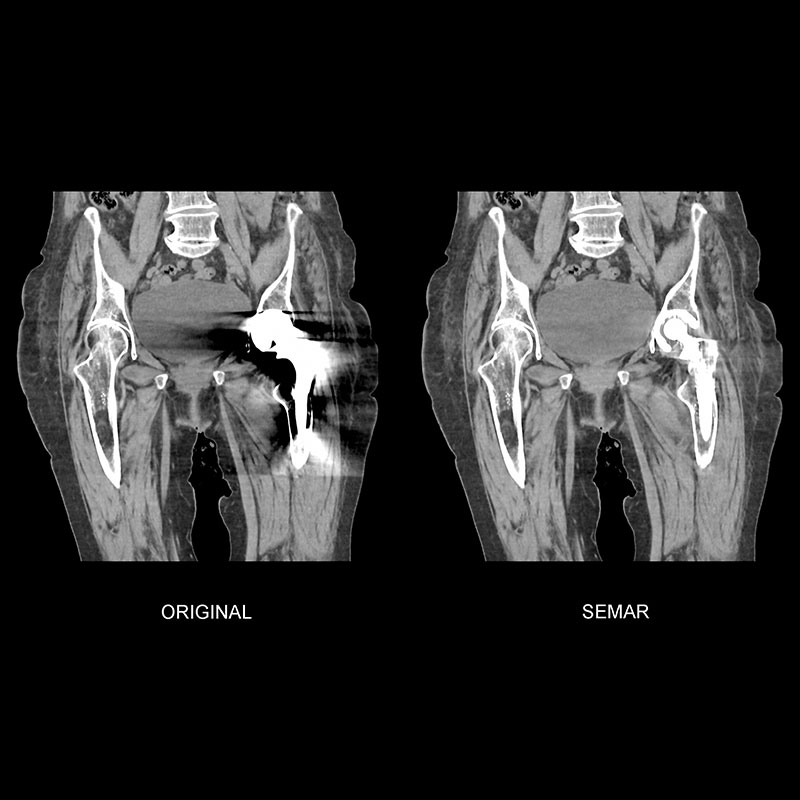 Aquilion Prime SP Left Hip Replacement