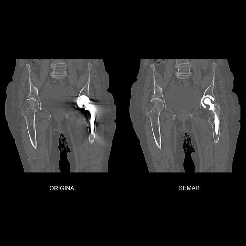 Aquilion Prime SP Left Hip Replacement