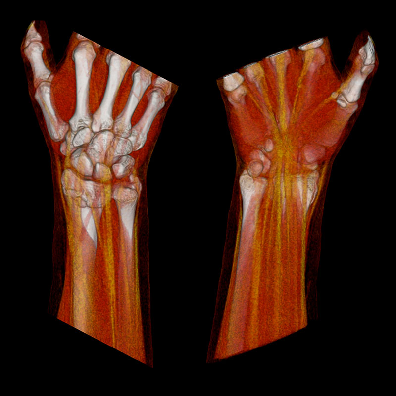 Aquilion Prime SP Radius Fracture