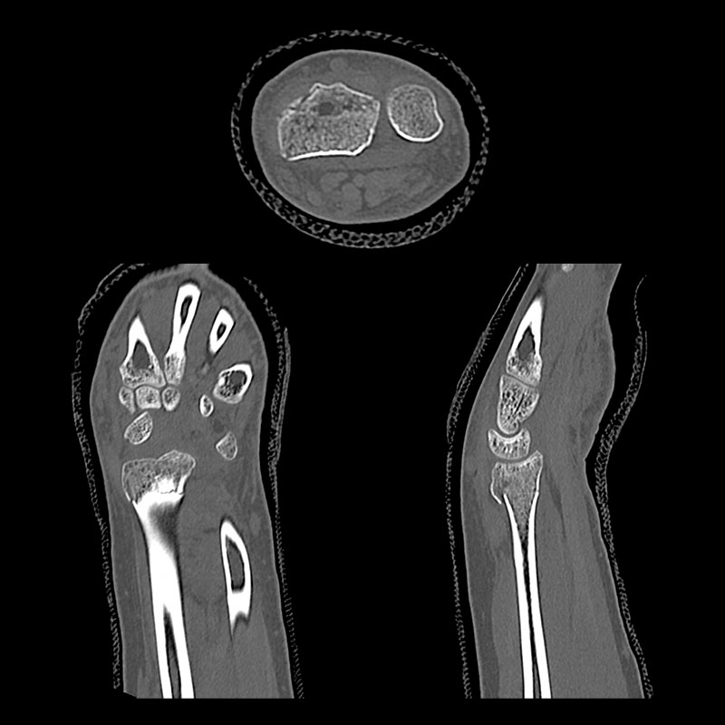 Aquilion Prime SP Radius Fracture
