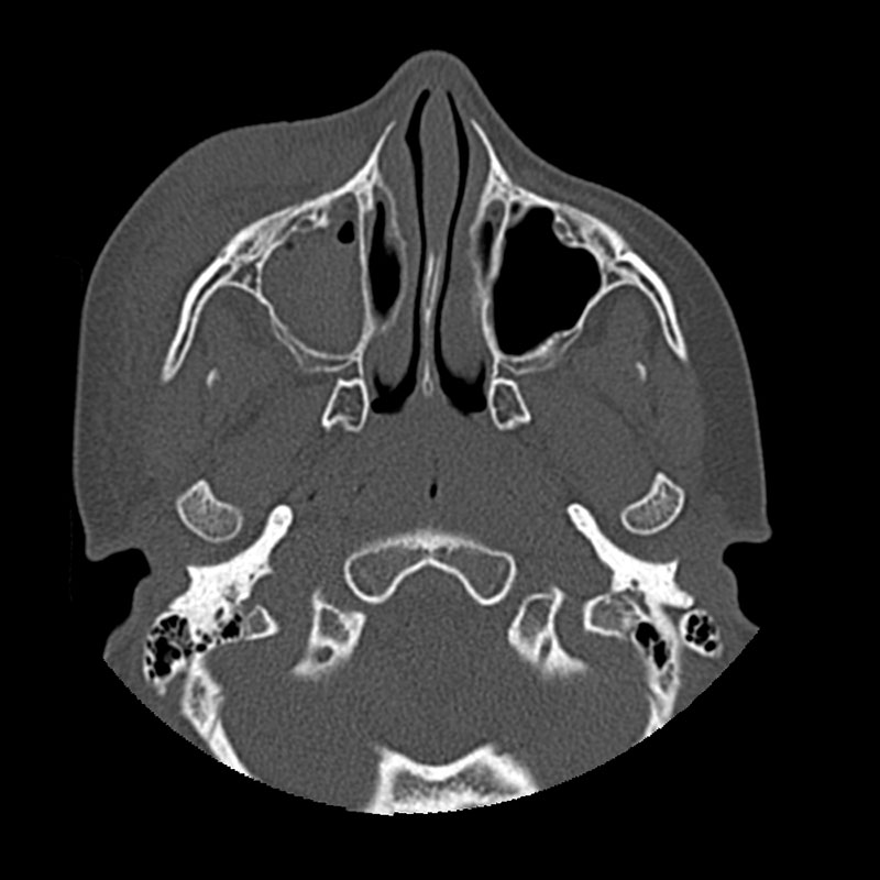 Aquilion Prime SP Facial Bones