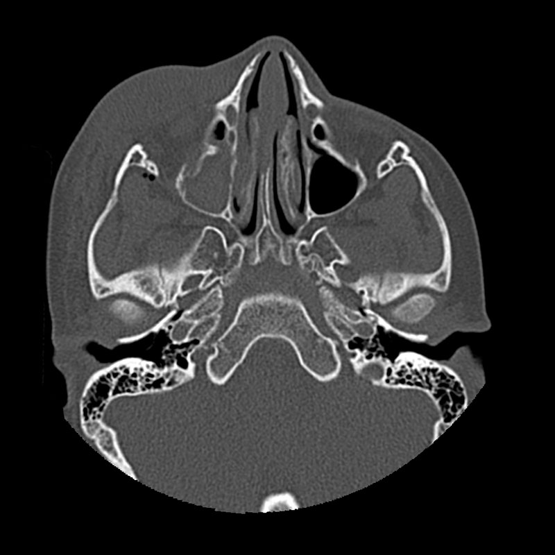 Aquilion Prime SP Facial Bones