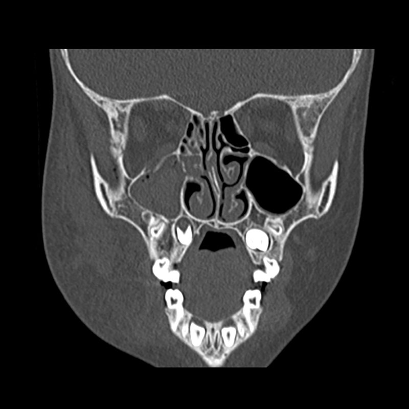 Aquilion Prime SP Facial Bones