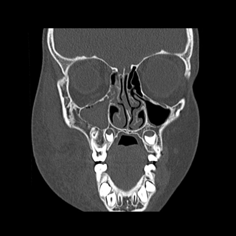 Aquilion Prime SP Facial Bones