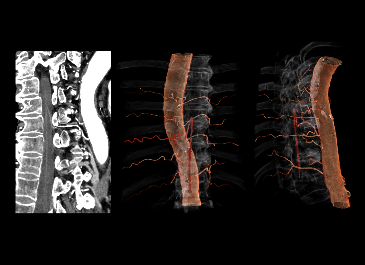 Adamkiewicz Artery