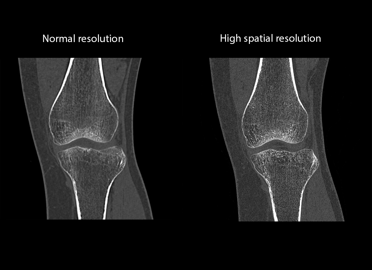 Photon Counting CT Knee1